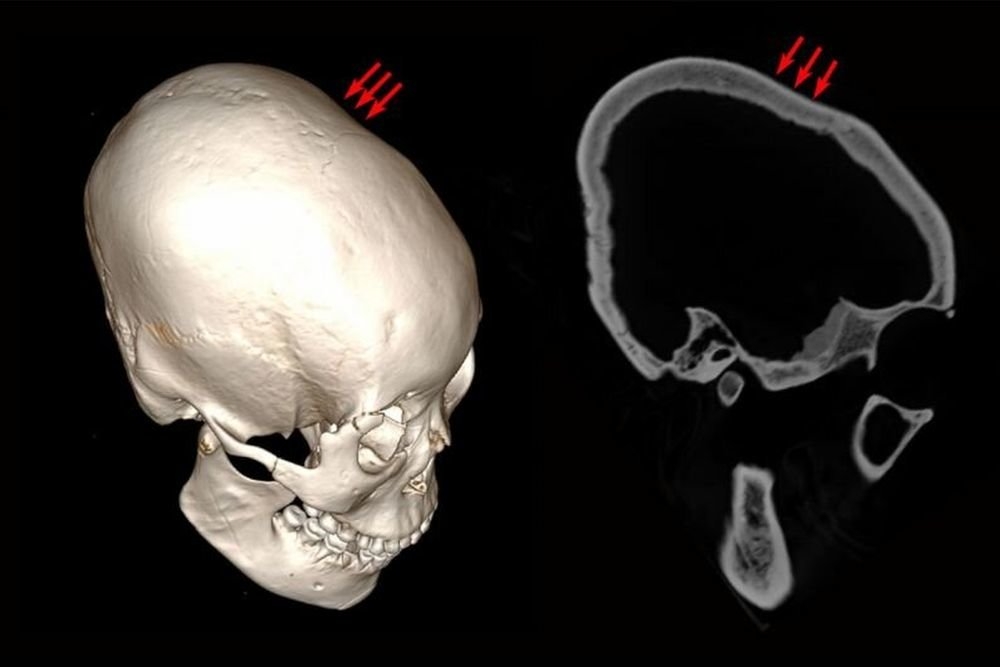 В Китае найдены длинные черепа возрастом 12 тысяч лет