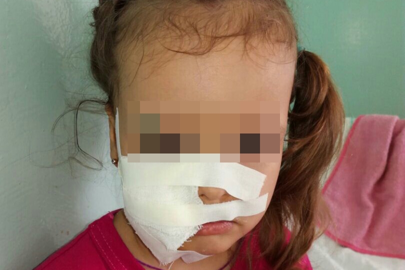 В Баку собака укусила за лицо трехлетнюю девочку
