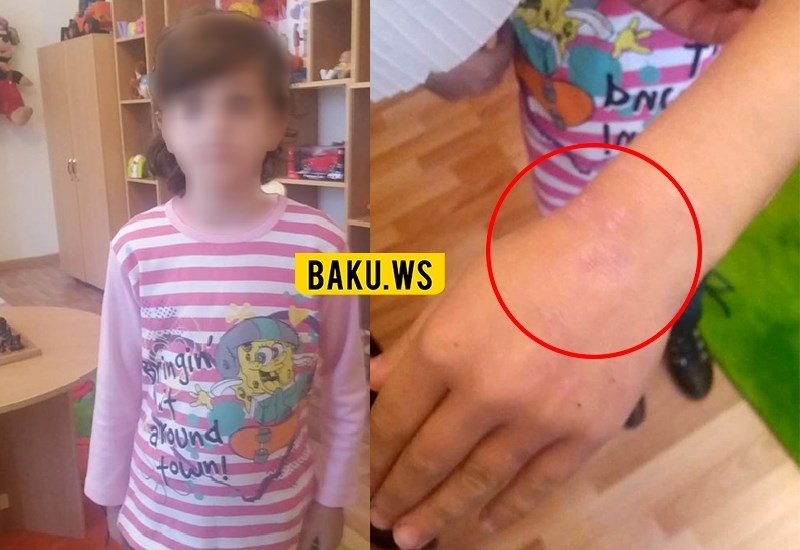 В Азербайджане мать тушила окурки сигарет на руке 10-летней дочери - ФОТО
