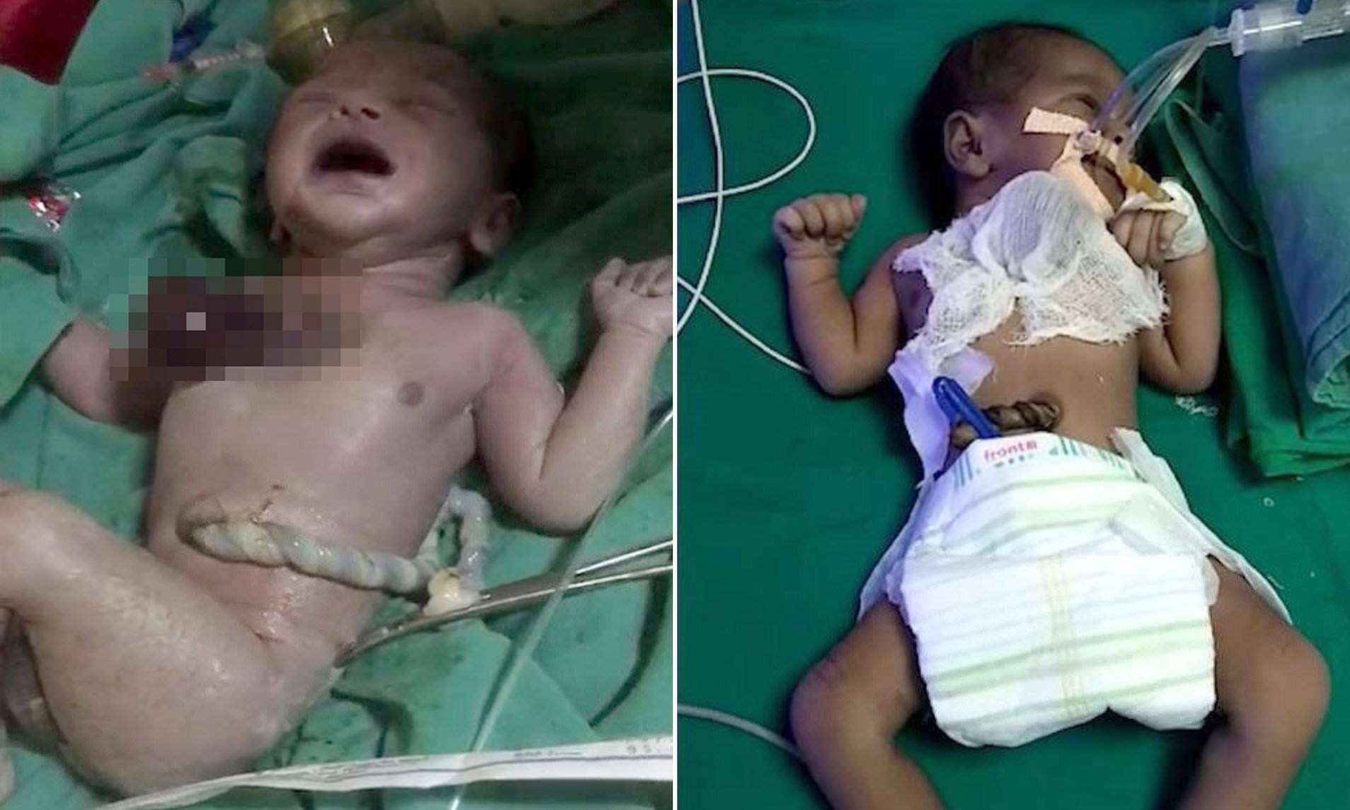 В Индии родился ребенок с сердцем наружу - ВИДЕО
