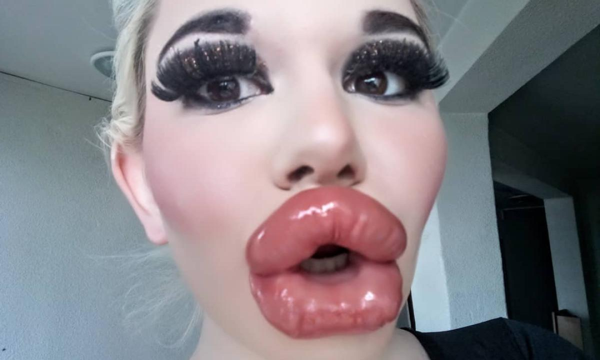 "Я люблю их, но мне больно есть": девушка сделала себе самые большие губы в мире - ВИДЕО