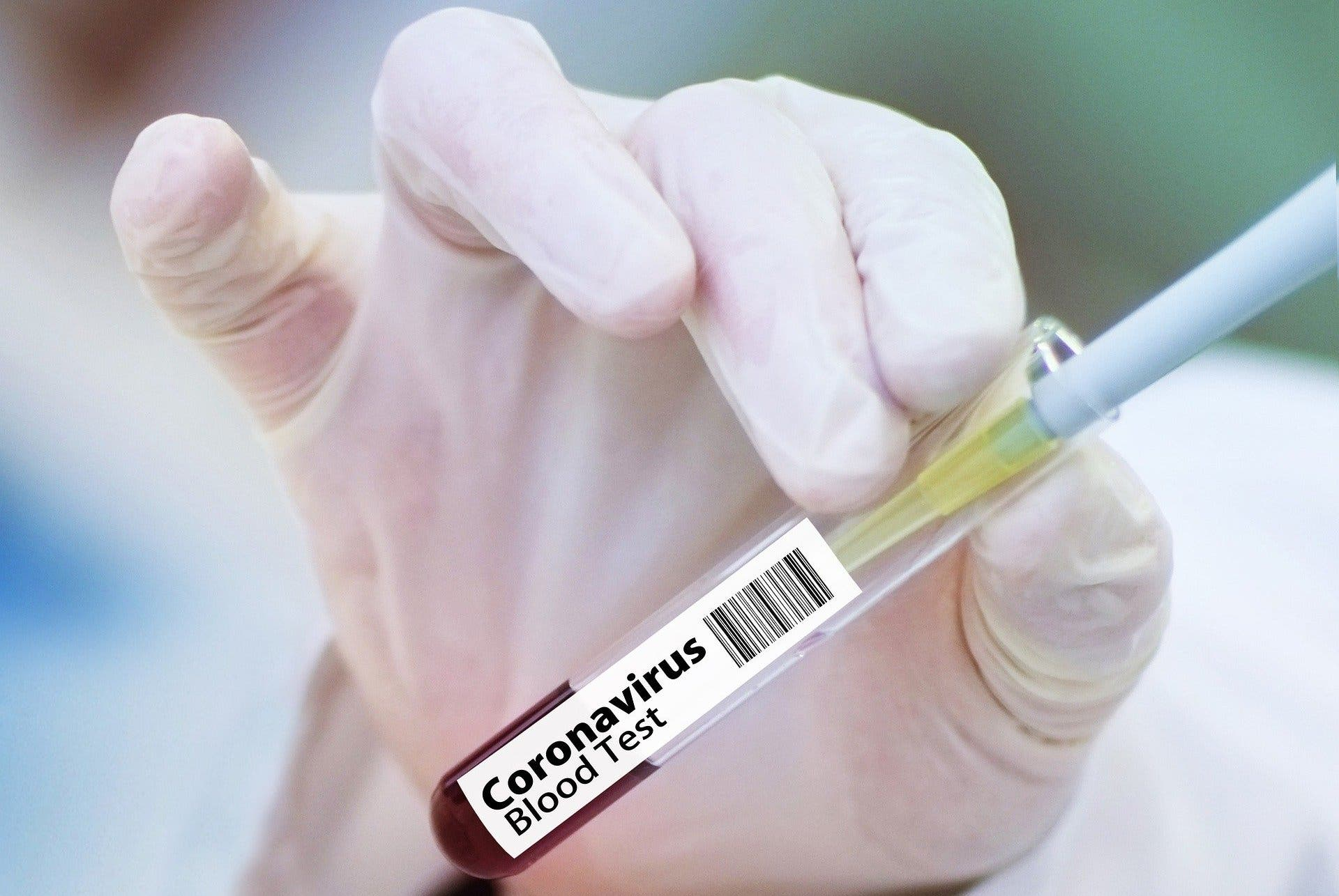 Количество проведенных в Азербайджане тестов на коронавирус превысило 350 тыс.