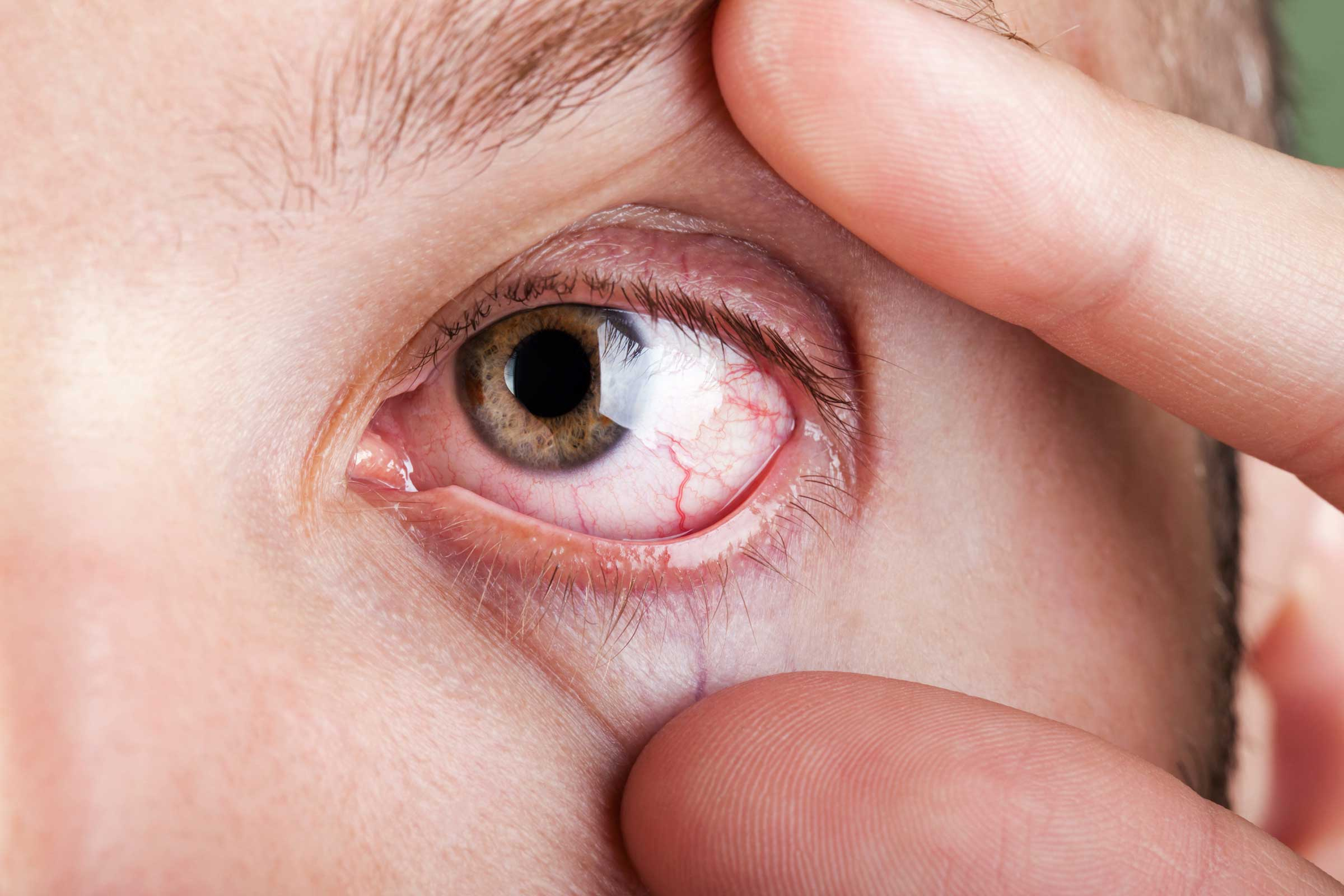 COVID-19 можно заразиться через глаза - Офтальмолог