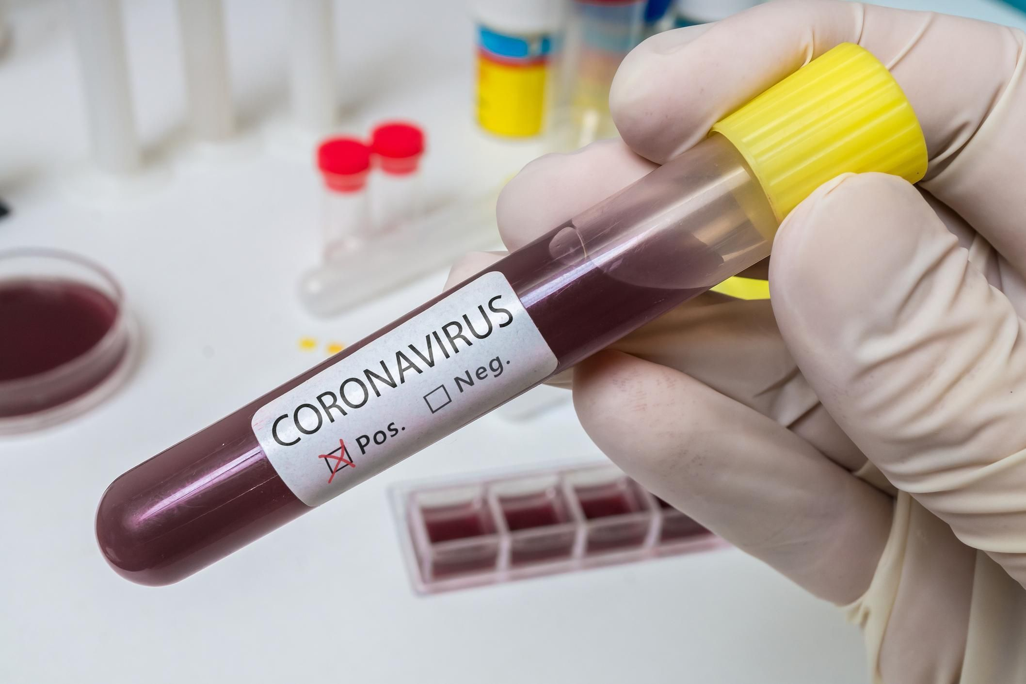 Обнародовано число заразившихся коронавирусом в Азербайджане за сутки - ФОТО