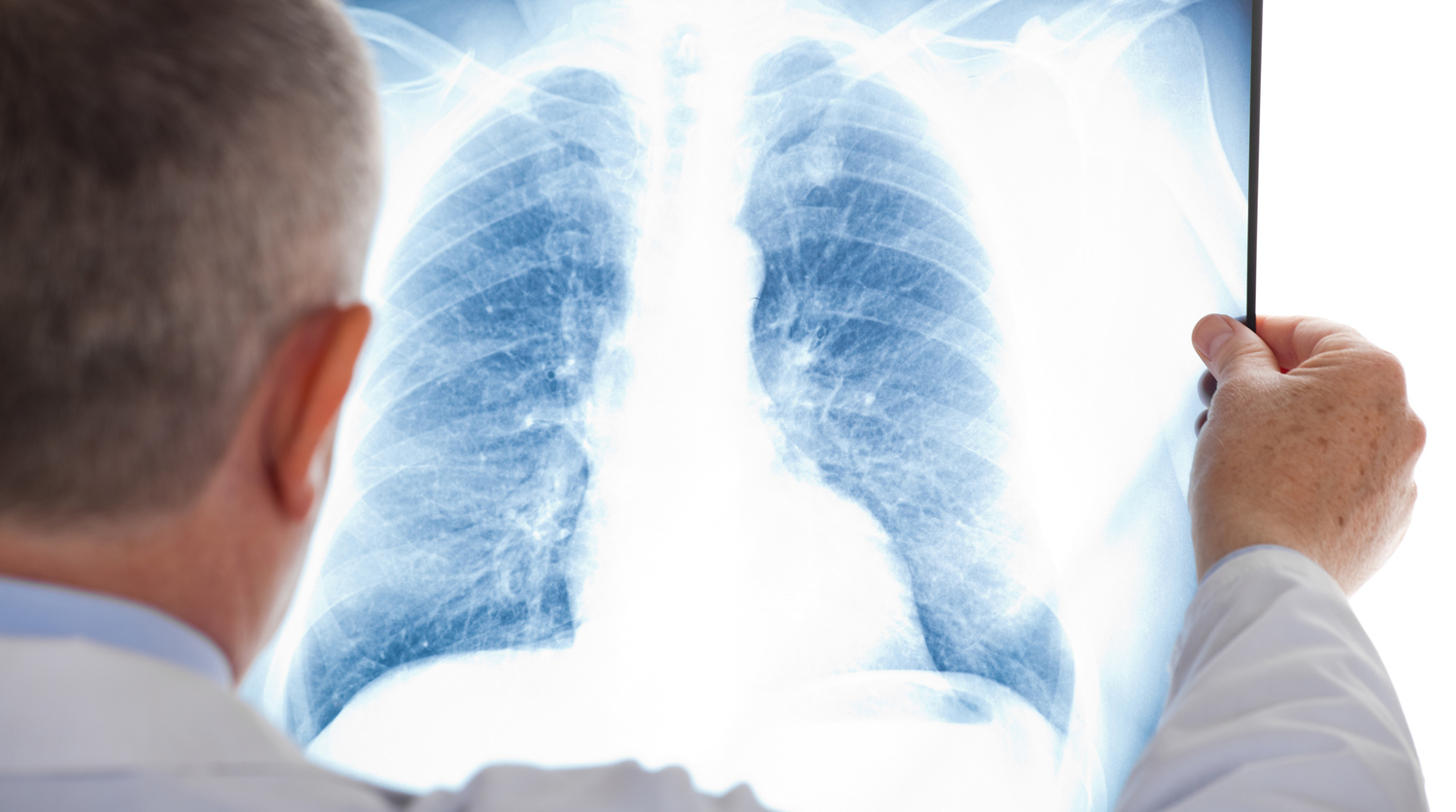 Эпидемиолог рассказал, кто чаще всего умирает от пневмонии
