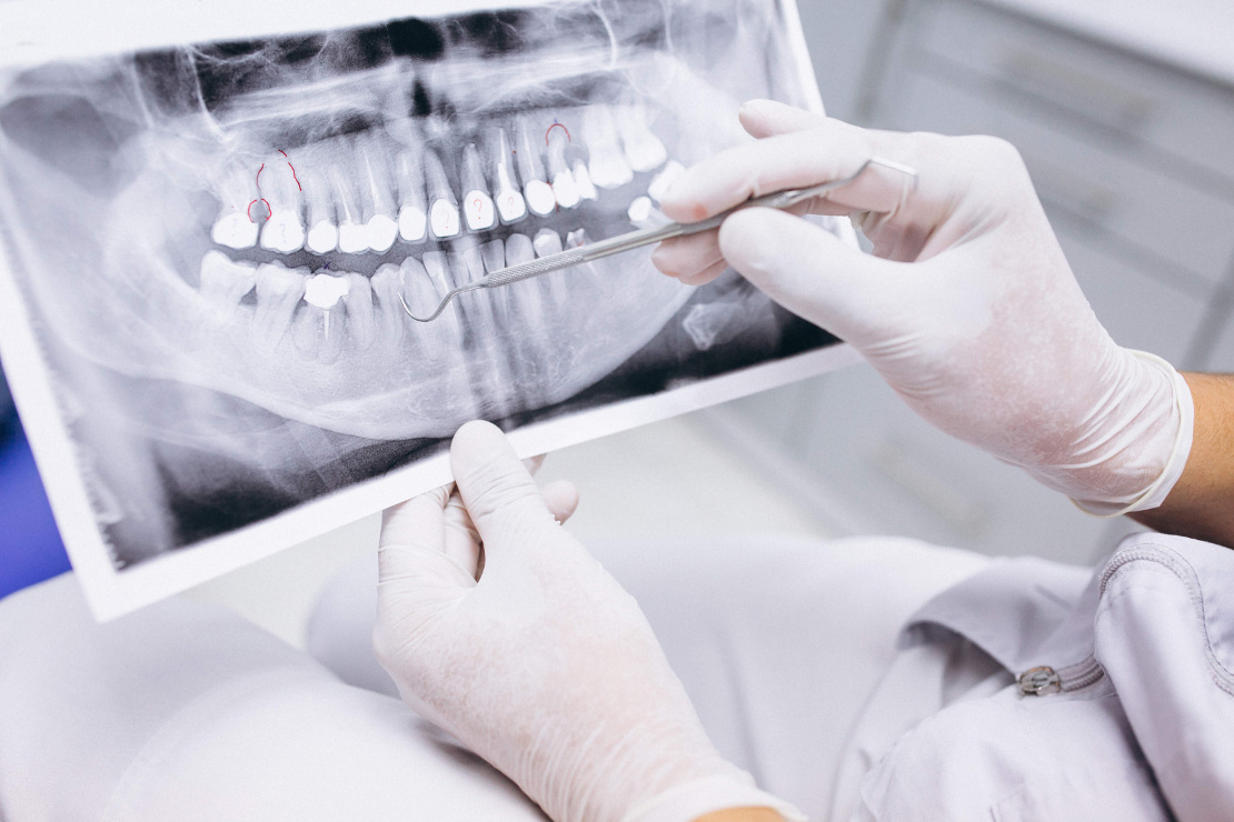 Ученые нашли способ выращивать новые зубы