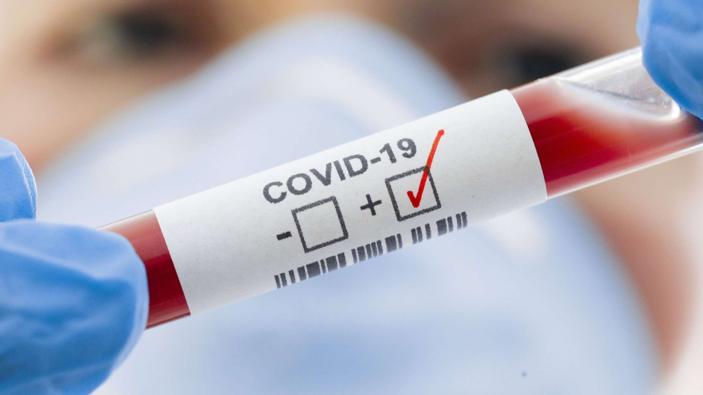 В Азербайджане за сутки COVID-19 заразились 69 человек