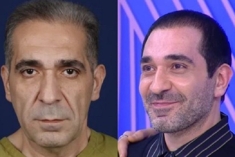 Похудевший на 40 кг азербайджанский певец преобразился после пластической операции - ФОТО