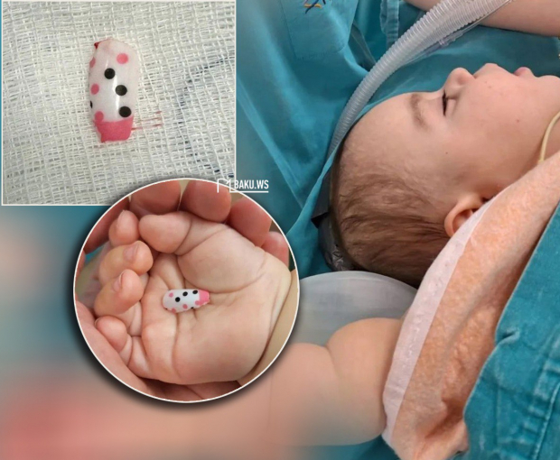 6-месячный ребенок проглотил пластиковый ноготь - ФОТО