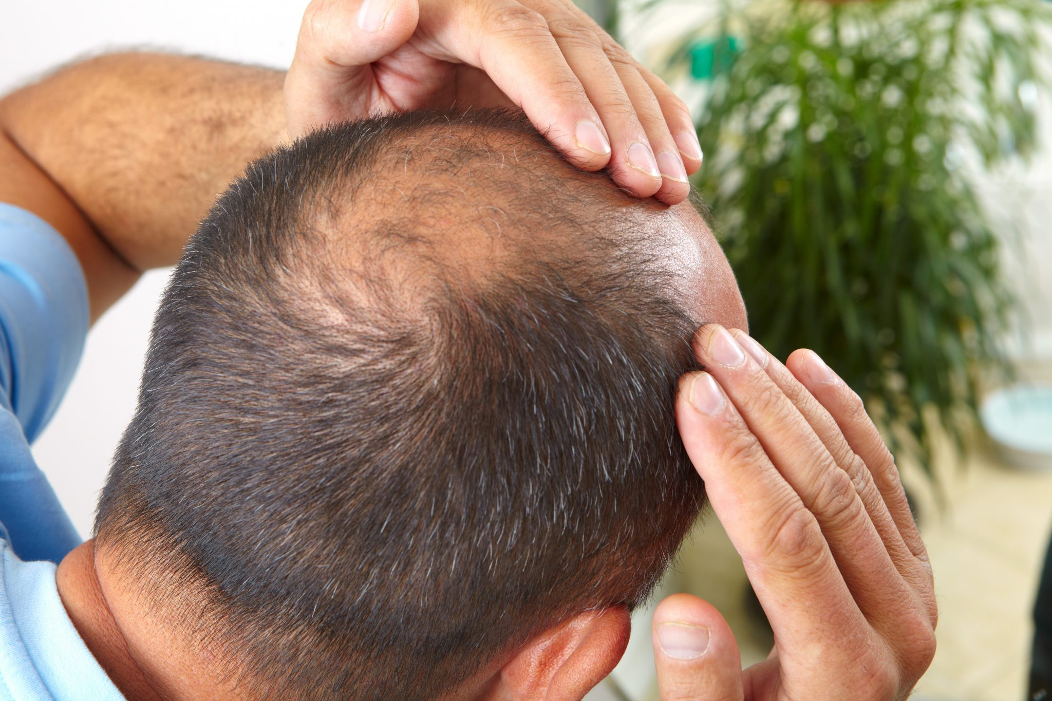 Выпадение волос как характерная черта кавказских народов: врач назвал причину