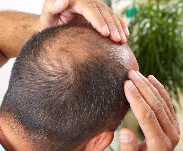 Выпадение волос как характерная черта кавказских народов: врач назвал причину
